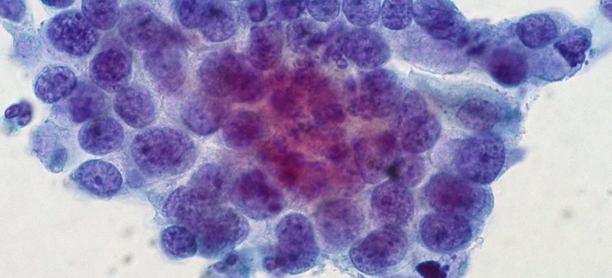 Genetic analysis of cervical cancers hints at targets for treatments