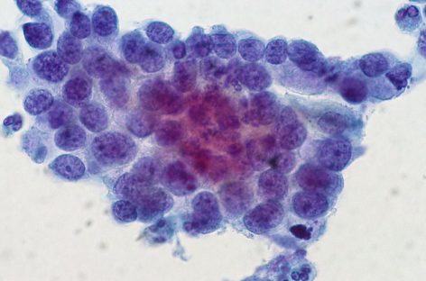 Genetic analysis of cervical cancers hints at targets for treatments